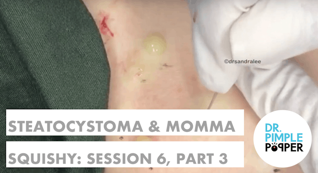 Steatocystomas & Momma Squishy: Session 6 Part 2B