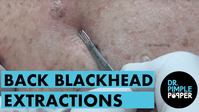 Back Blackhead Extractions After Mohs
