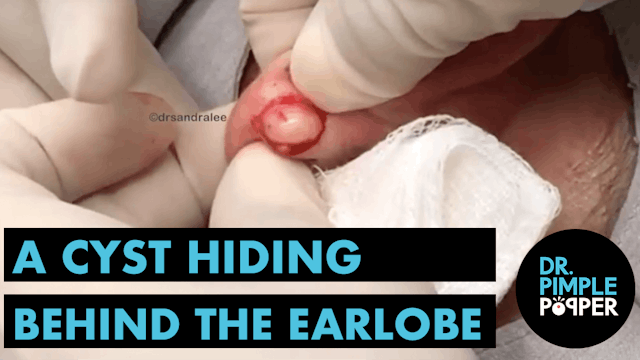 A Cyst Hiding Behind the Earlobe! Wit...