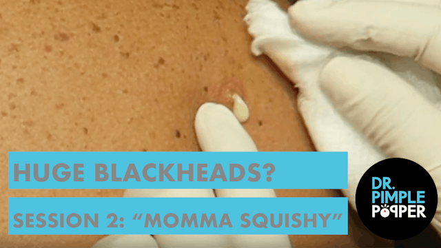 Huge Blackheads? Session Two with "Mo...