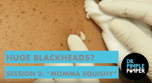 Huge Blackheads? Session Two with "Momma Squishy"
