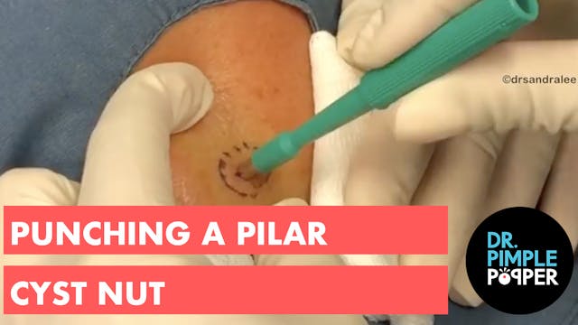 Punching a Pilar Cyst Nut