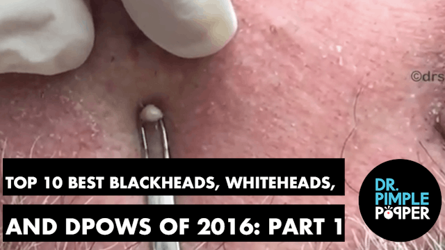 Dr Pimple Poppers Top 10 Cysts of 201...