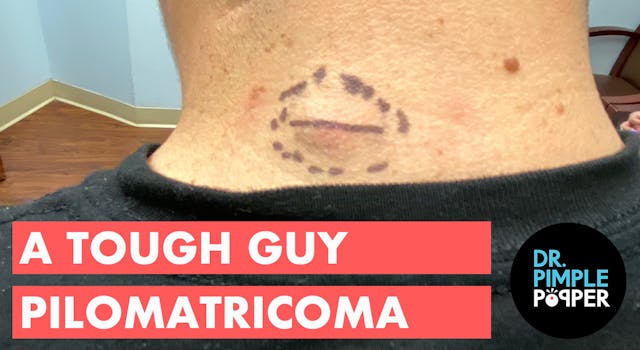 A Tough Guy Pilomatricoma