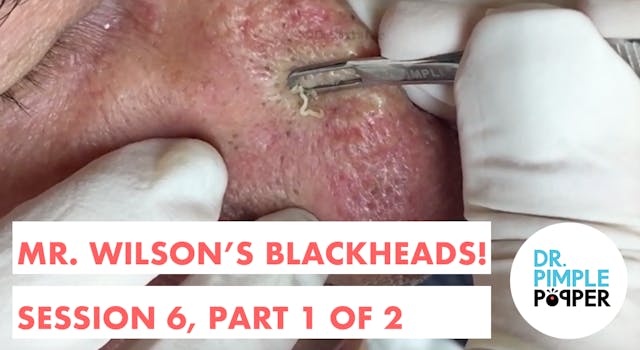 Mr Wilson's Blackheads! Session 6, Pa...
