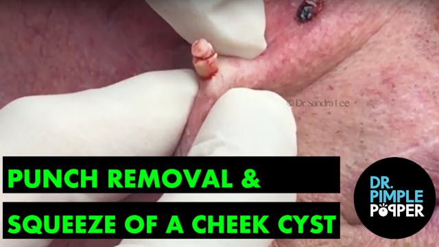 Punch removal & squeeze of a cyst on ...