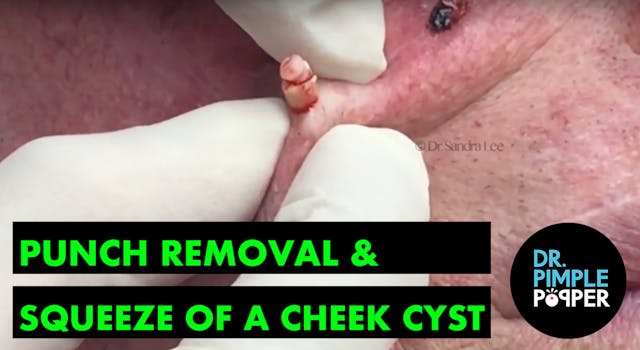 Punch removal & squeeze of a cyst on ...