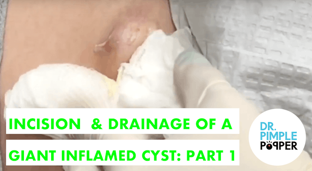 WEB EXCLUSIVE: Incision & Drainage of...