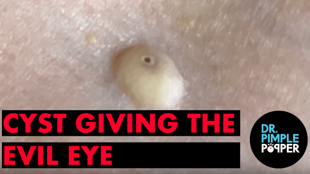 Cyst Giving Evil Eye