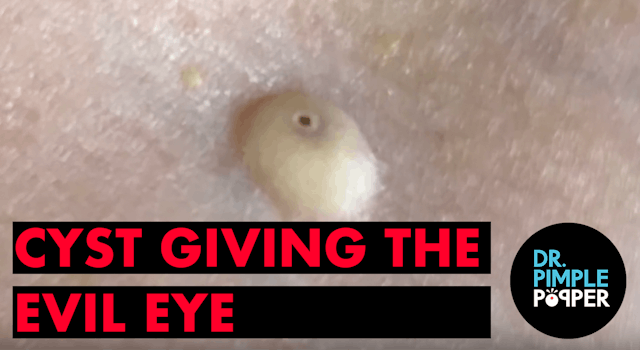 Cyst Giving Evil Eye