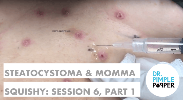 Steatocystomas & Momma Squishy: Session Six, Part 1