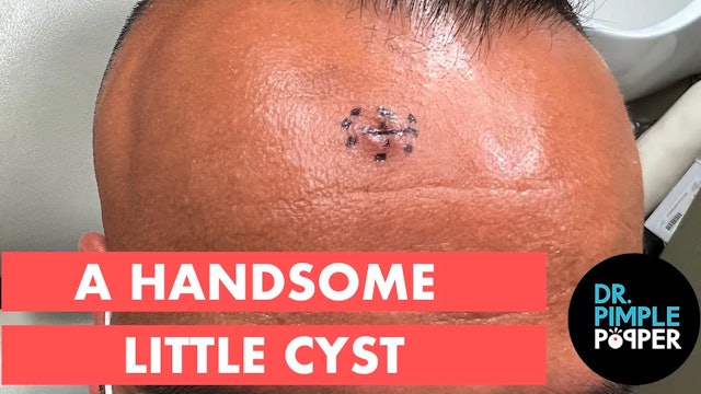 A Handsome Little Cyst