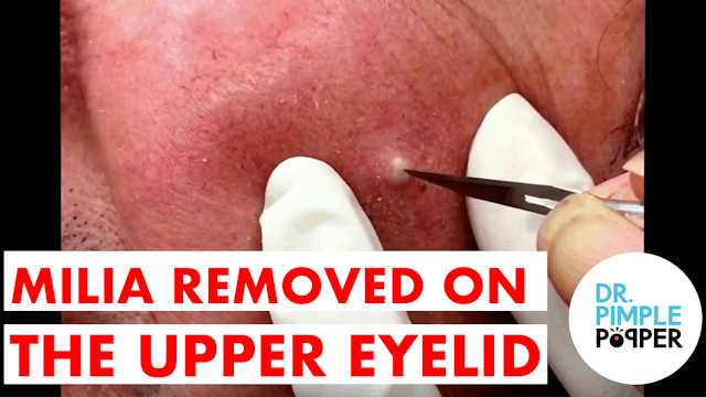 Milia Removed on the Upper Eyelid