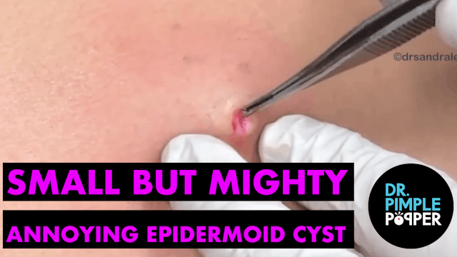 Small but Mighty Annoying Epidermoid Cyst