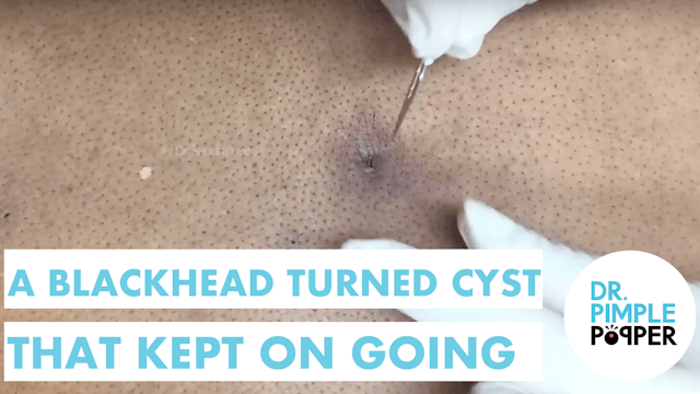 Heres a Blackhead Turned Cyst that Kept Going