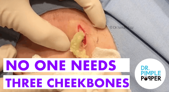 No One Needs Three Cheekbones