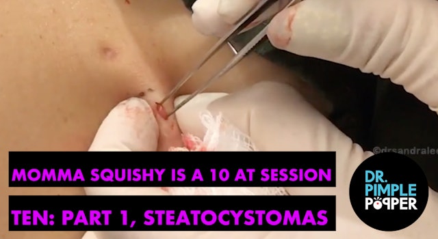 Momma Squishy is a 10 at Session Ten! Part 1, Steatocystomas