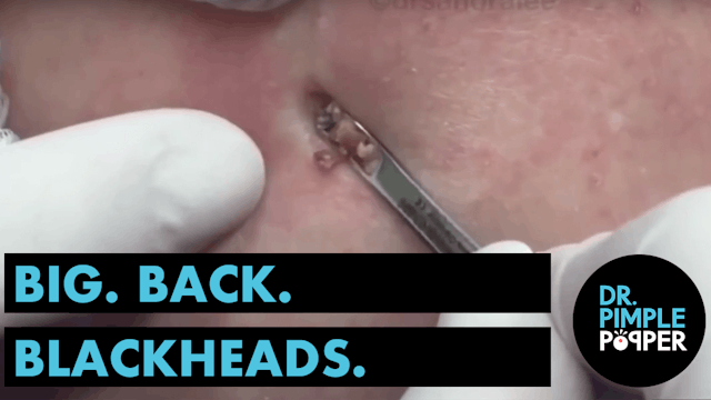 Big. Back. Blackheads