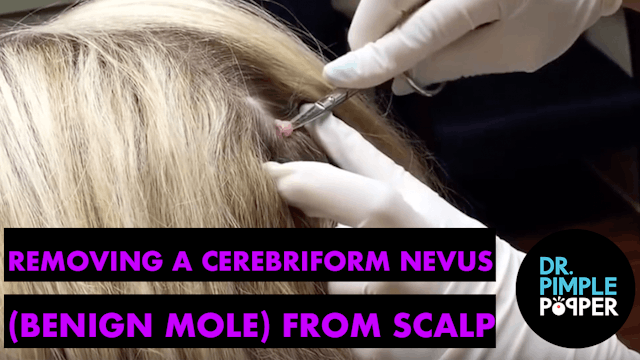 Removing a Cerebriform Nevus (Benign Mole) on Scalp