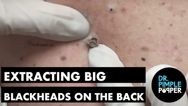 Extracting Big Blackheads on the Back...