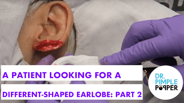 A patient looking for a different Earlobe found Dr Pimple Popper! Part Two