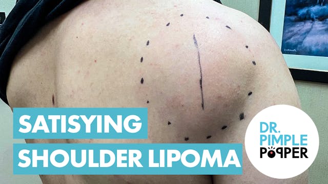 Satisfying Shoulder Lipoma