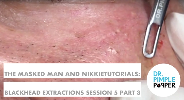 The Masked Man, Dr Pimple Popper, & NikkieTutorials! Session 5, Part 3