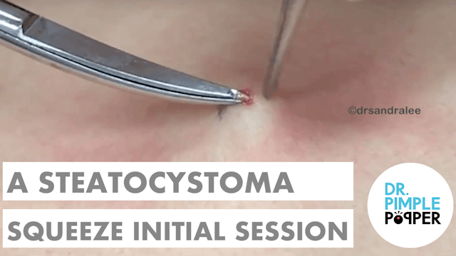 A Steatocystoma Squeeze Initial Session