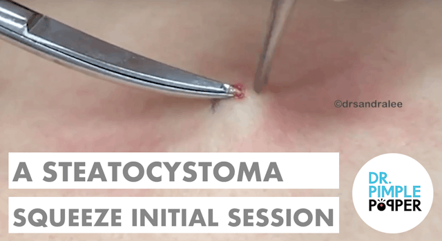 A Steatocystoma Squeeze Initial Session