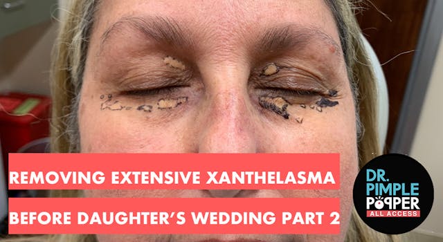 EXCLUSIVE - Removing Extensive Xanthe...