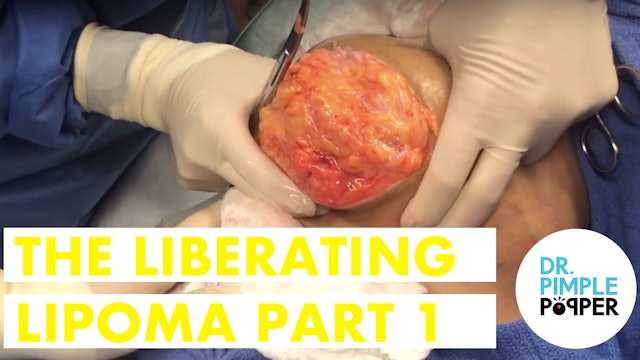 The Liberating Lipoma Part 1