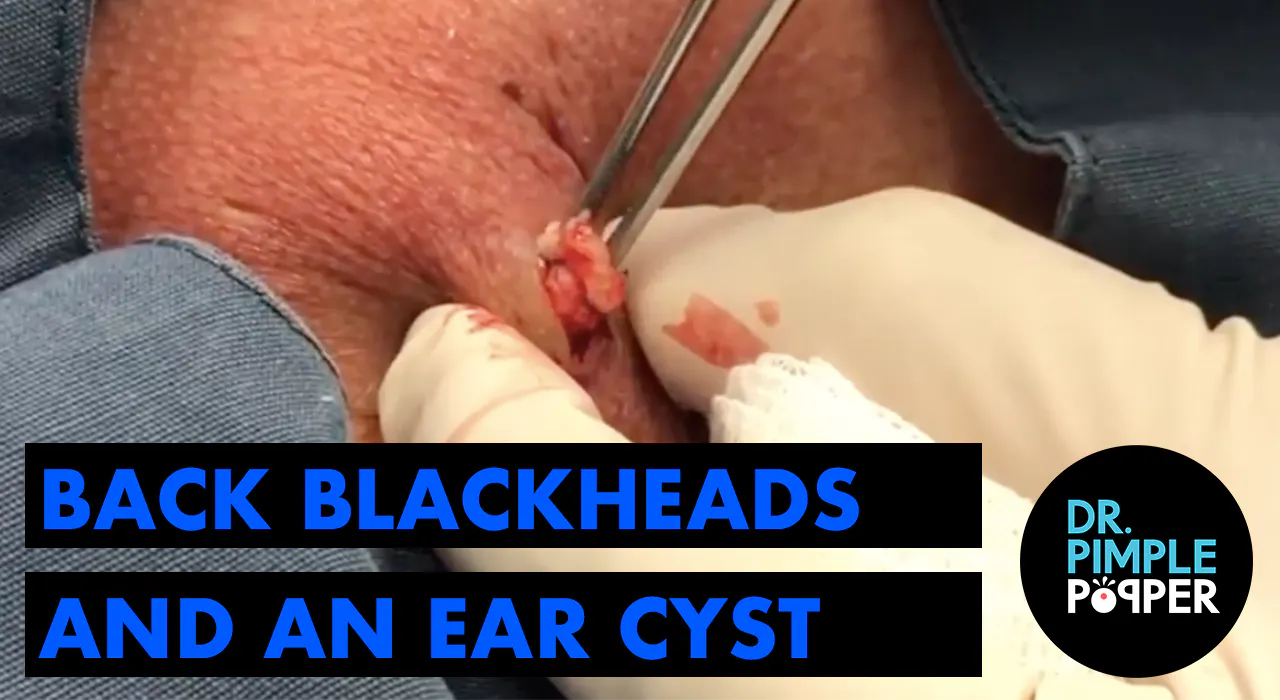 Dr Pimple Popper Blackheads In Ears