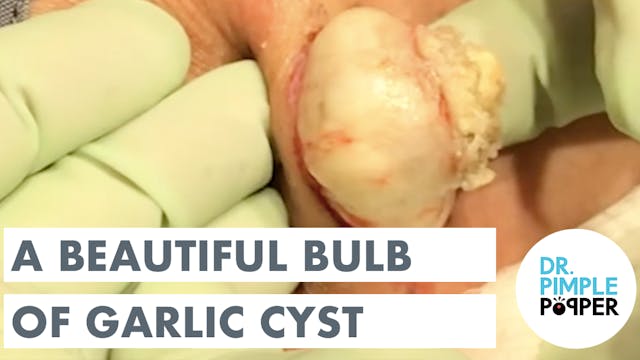 A Beautiful Bulb of Garlic Cyst