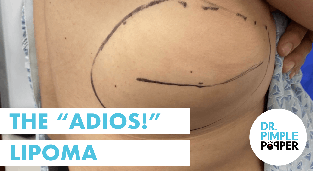 The Adios Lipoma! - Lipoma Love - Dr. Pimple Popper