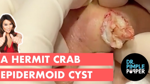 The Hermit Crab Cyst