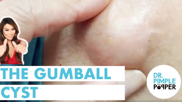 The Gumball Cyst
