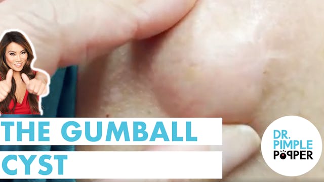 The Gumball Cyst