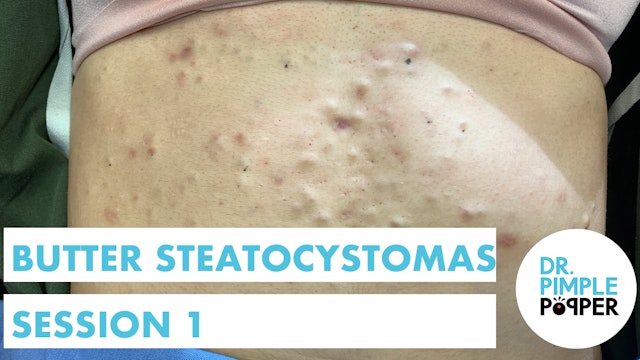 Butter Steatocystomas: Session 1