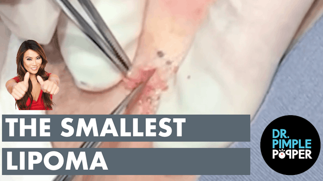 The Smallest Lipoma