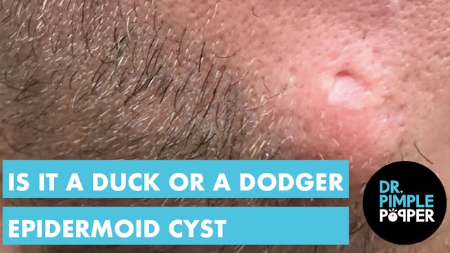 Is it a Duck or a Dodger Cyst? 