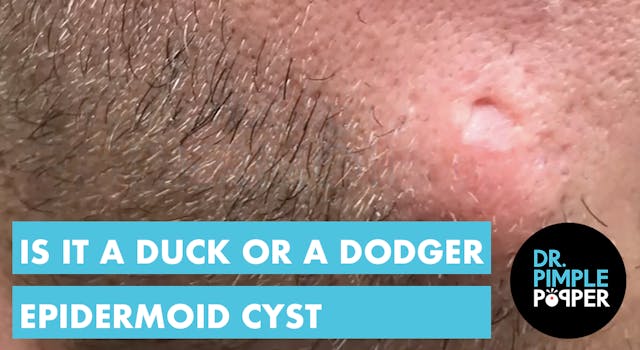 Is it a Duck or a Dodger Cyst? 