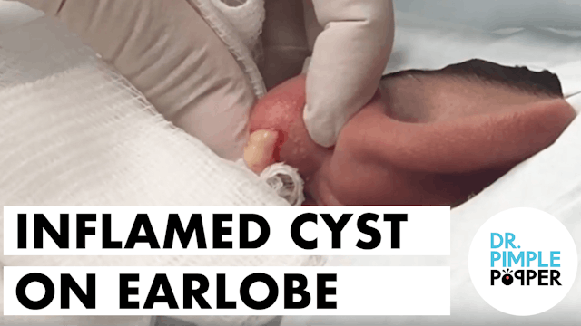Inflamed Cyst on Earlobe & Some Blackhead Extractions!