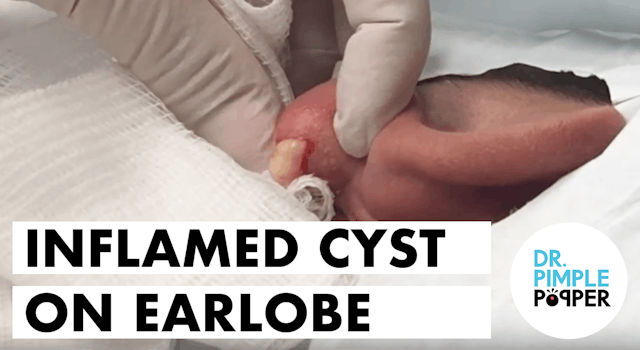 Inflamed Cyst on Earlobe & Some Black...
