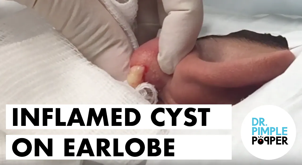 Dr Pimple Popper Blackhead Removal