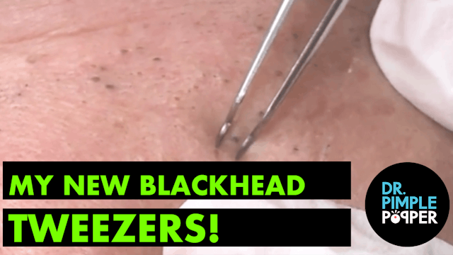 My New Blackhead Tweezers!