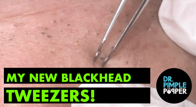 My New Blackhead Tweezers!