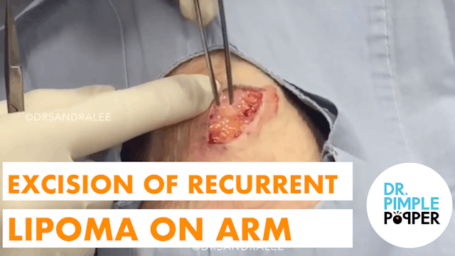 Excision of a Recurrent Lipoma