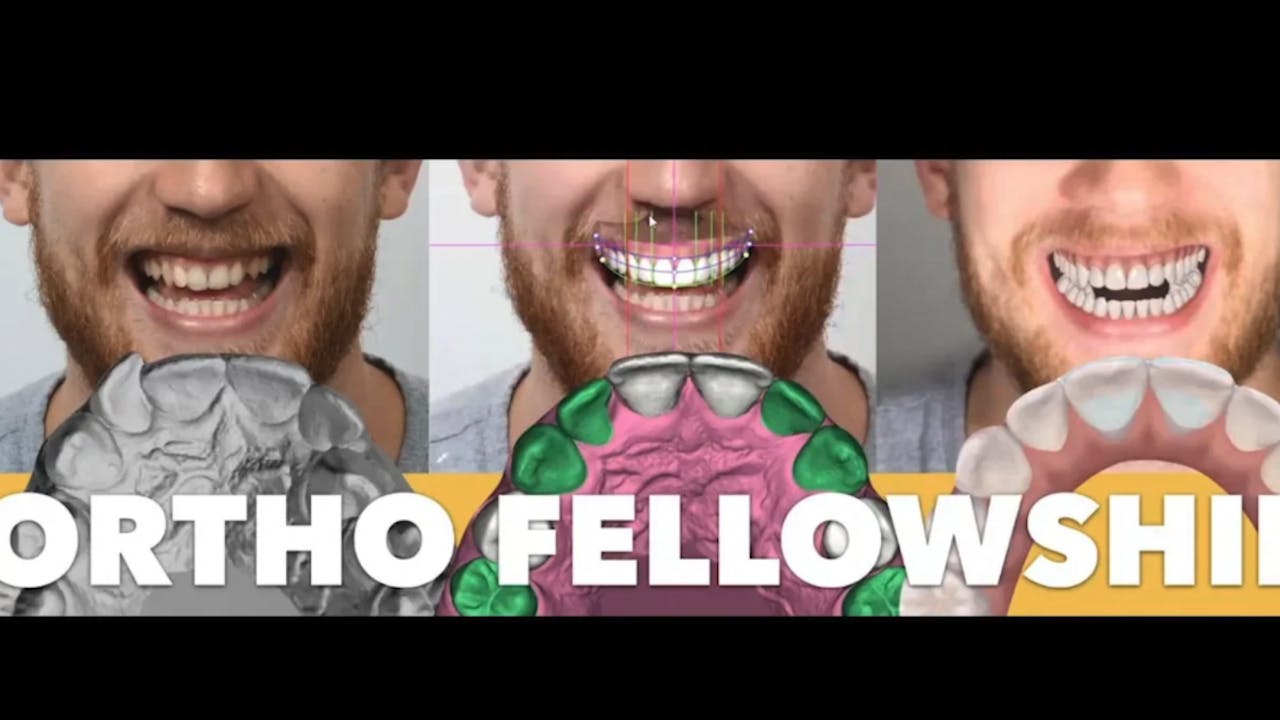 Role of Digital Dentistry Dr. Coachman Orthodontic Aligner