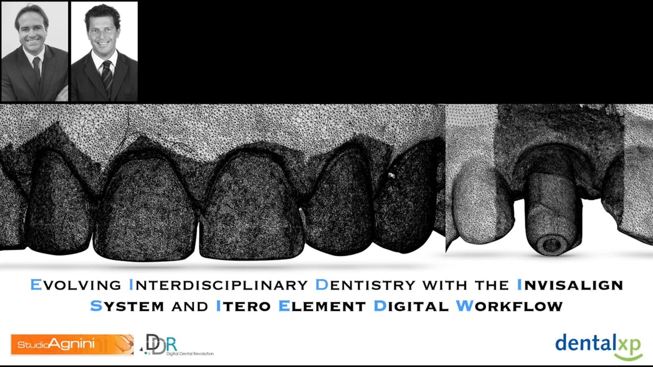 Using iTero for restorative purposes Part 1 Andrea Agnini