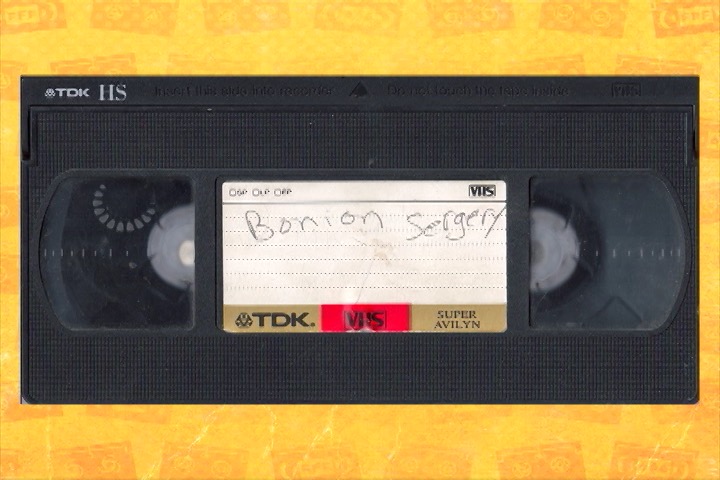 Bonion Sergery Parts 1, 2 and 3